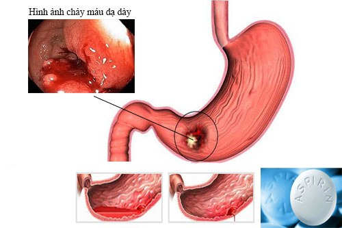 Loại thuốc hạ sốt nào không được dùng khi sốt xuất huyết?