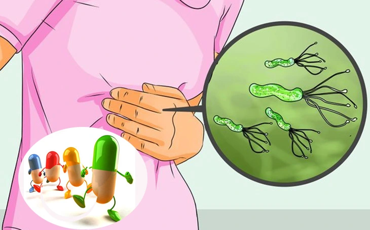 Cách dùng thuốc trị vi khuẩn H.Pylori hiệu quả để dự phòng viêm loét dạ dày
