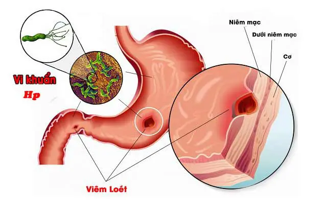 4 biện pháp phòng ngừa viêm loét dạ dày